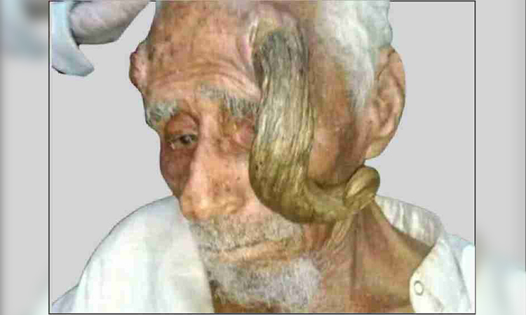 140-year-old Yemeni man with horns dies after amputating them 