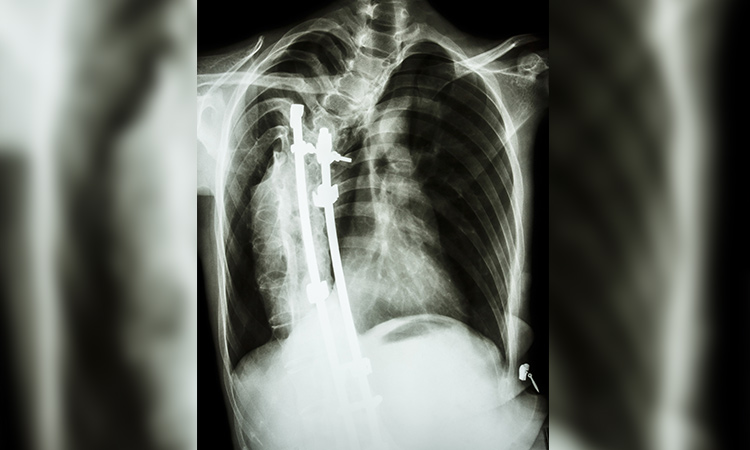 Correcting the curve with scoliosis surgery