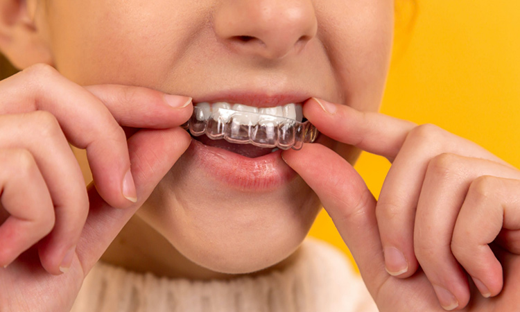 Busting myths around aligners and braces