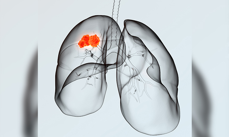 Reducing your risk of lung cancer