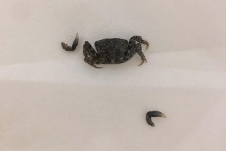 Doctor takes out a baby crab from man’s ear in Abu Dhabi