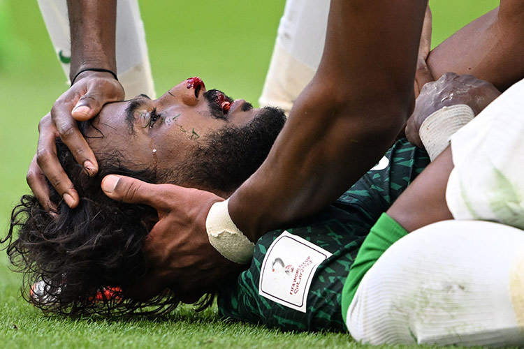 Yasser Al Shahrani suffers broken jaw and internal bleeding after horrific collision with goalkeeper during Argentina match