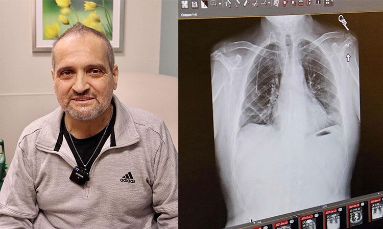 Double lung transplant saves US citizen with terminal cancer