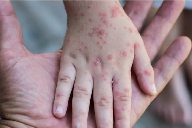 US reports 25,341 monkeypox cases this year