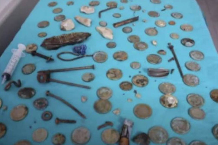 Doctors in Turkey take out 233 coins, batteries and nails from a man's stomach