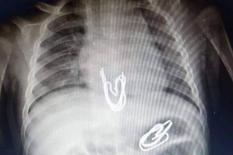 Doctors extract five metal pins from 3-month-old baby’s stomach in Egypt