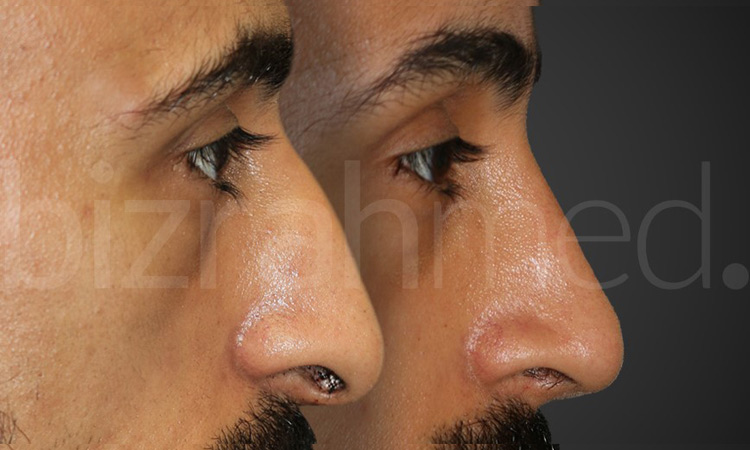 Nose Jobs: Top 5 reasons people choose Bizrahmed