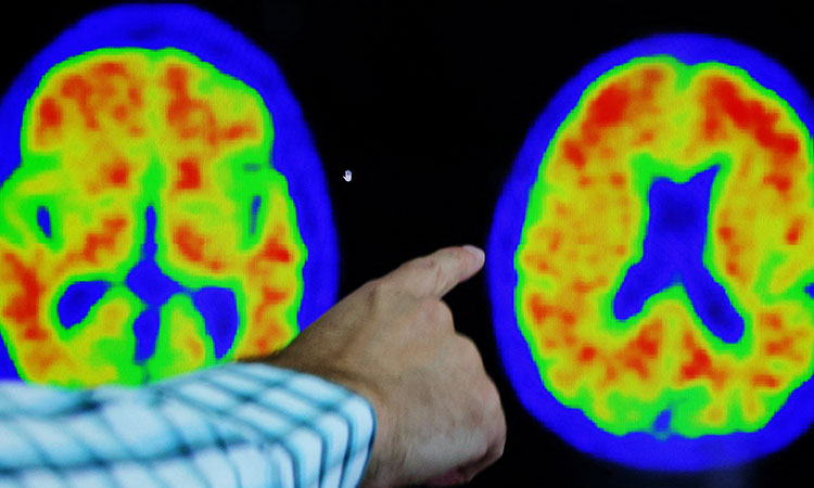 Drug slows Alzheimer's by 60% for mildly impaired patients in trial