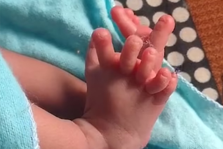 Girl born with 26 fingers, family calls her goddess' incarnation in India