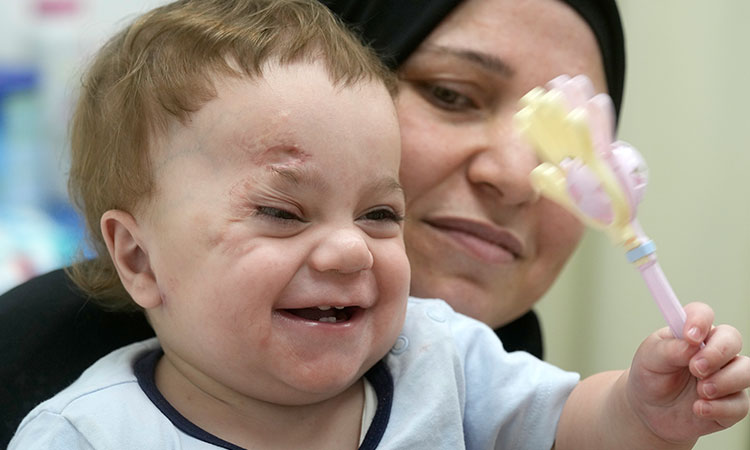 A baby evacuated from Gaza lost an eye and most of his family in the war