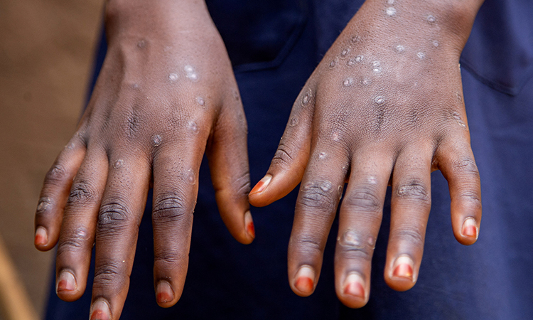 UNICEF issues emergency tender to secure mpox vaccines for crisis-hit countries