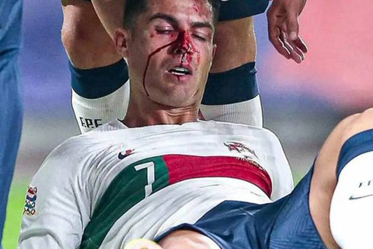 VIDEO: Ronaldo suffers a severe face injury during the Portugal-Czech match